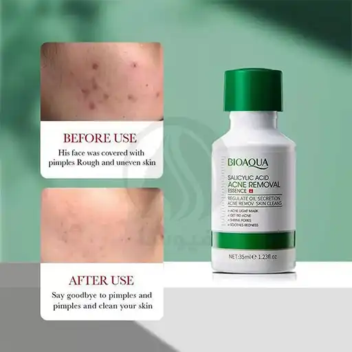 Bioaqua Salicylic Acid Anti-Acne Serum