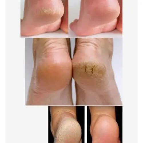 پخش کرم ترک پا بلورین – BLUREEN تک و عمده کد R106