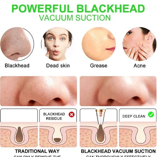 Microdermabrasion-new-model-code-g5624