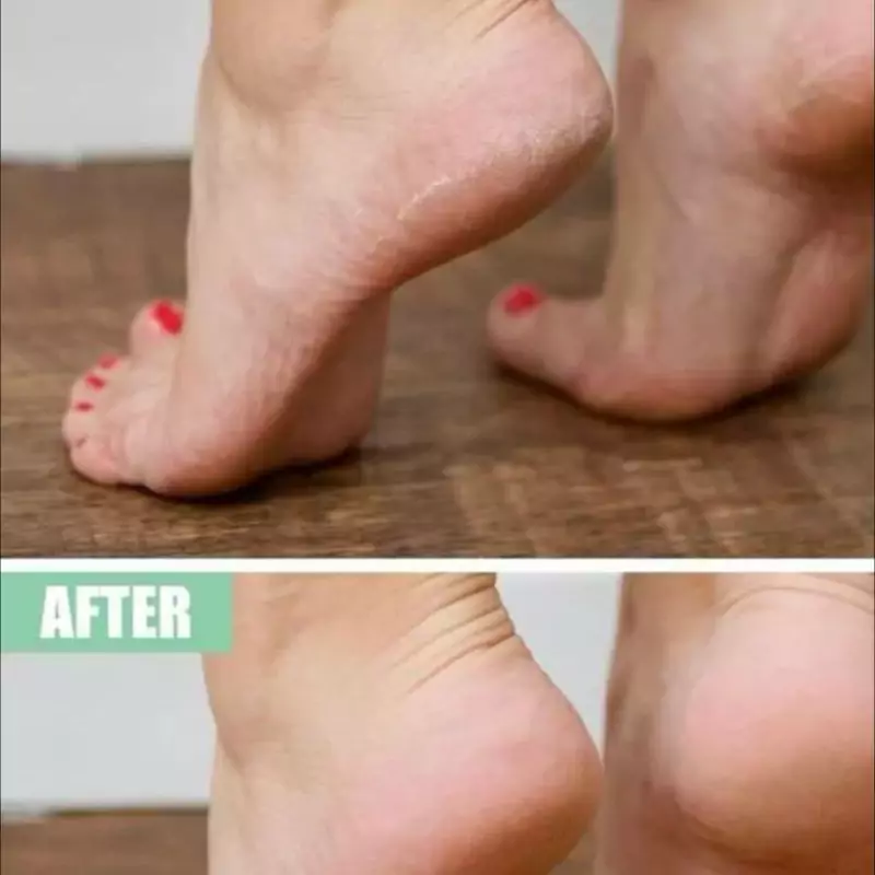 Buy-heel-balm-cream-for-cracked-feet