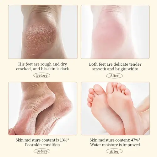 Buy-heel-balm-cream-for-cracked-feet