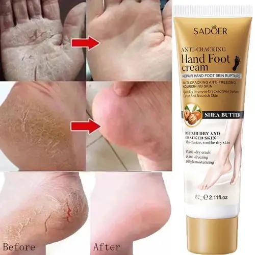 Buy-heel-balm-cream-for-cracked-feet
